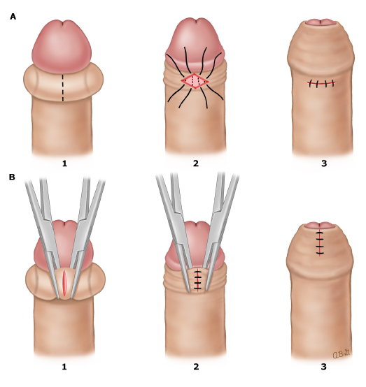 parafimosi